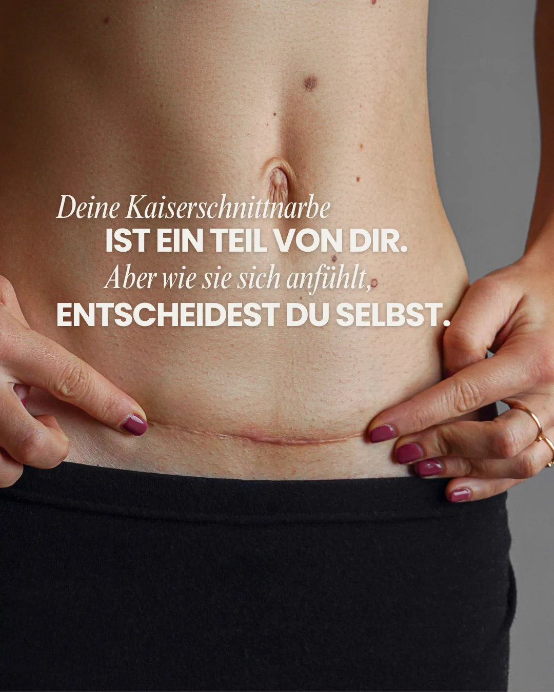 Ein Kaiserschnitt ist ein Zeichen für ein Wunder. Trotzdem fühlen sich einige Frauen durch ihre verbleibende Narbe unwohl.
Zum Glück gibt es Möglichkeiten, sie verblassen zu lassen und das Wohlbefinden wieder zu steigern. 🌸
Vereinbare jetzt einen Beratungstermin und erfahre, wie wir dir und deiner Haut etwas Gutes tun können. 📅
#SchöneHaut #Kaiserschnittnarbe #Narbenbehandlung
Mit Unterstützung von KI erstellt.