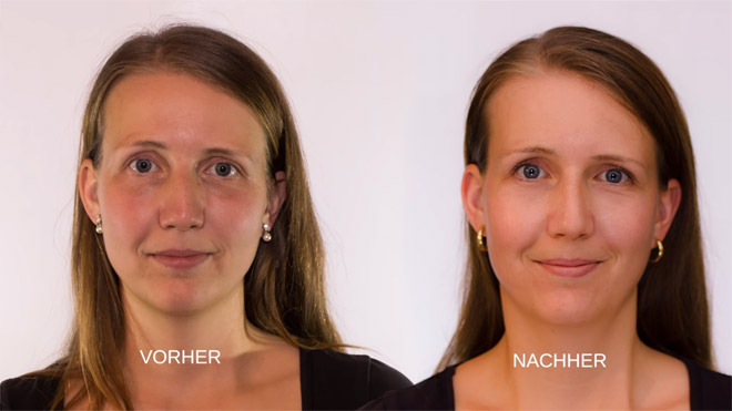Asthetische Dermatologie Berlin Zehlendorf Augenringbehandlung